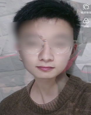 �������µĺۼ���Ч���������������µĺۼ���Ƶ������ϸ����