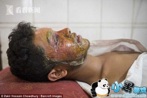 拒绝求爱遭泼硫酸是怎么回事 男子拒绝求爱遭泼硫酸被毁容了吗/对方被逮捕了吗 拒绝求爱遭泼硫酸是怎么回事 男子拒绝求爱遭泼硫酸被毁容了吗/对方被逮捕了吗