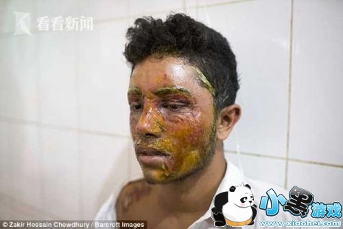 拒绝求爱遭泼硫酸是怎么回事 男子拒绝求爱遭泼硫酸被毁容了吗/对方被逮捕了吗 拒绝求爱遭泼硫酸是怎么回事 男子拒绝求爱遭泼硫酸被毁容了吗/对方被逮捕了吗